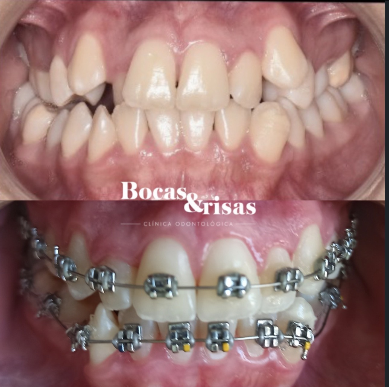Antes y después de tratamiento de ortodoncia con brackets en Bocas y Risas Medellín