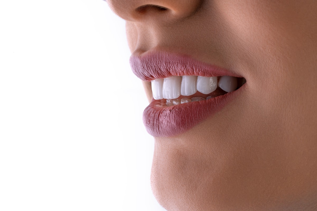 Carillas dentales