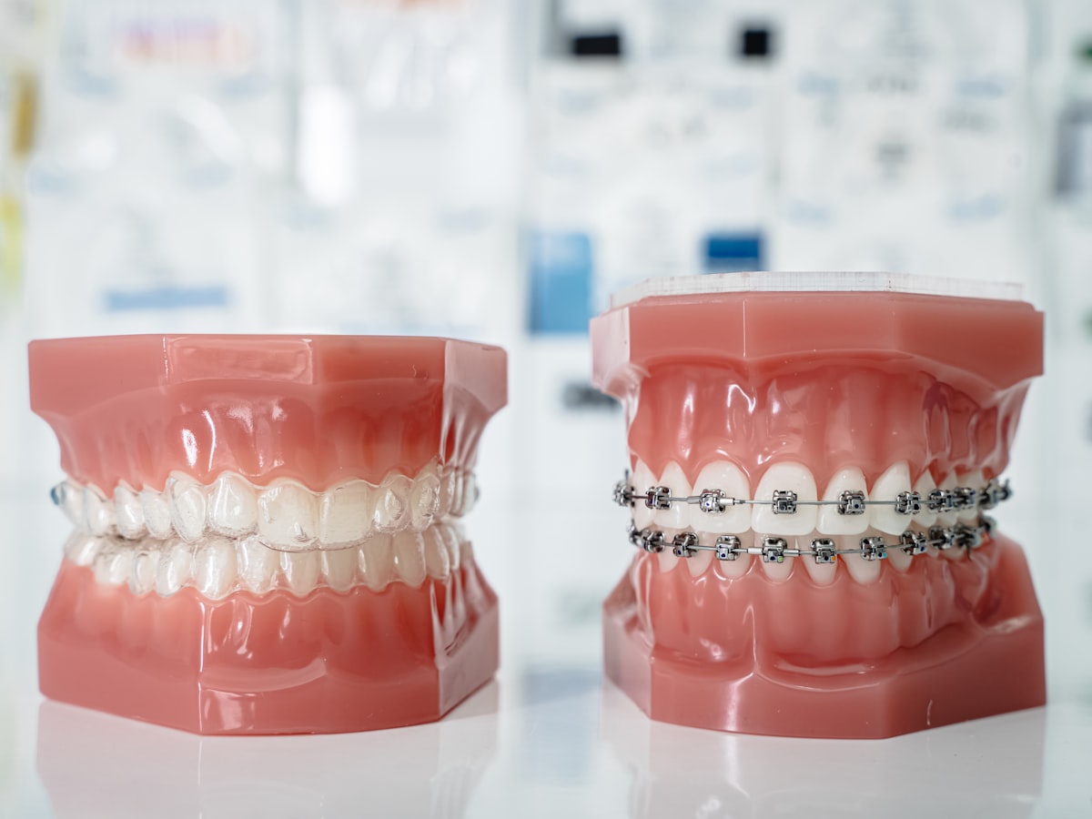 Comparación de modelos dentales con alineador transparente y brackets metálicos