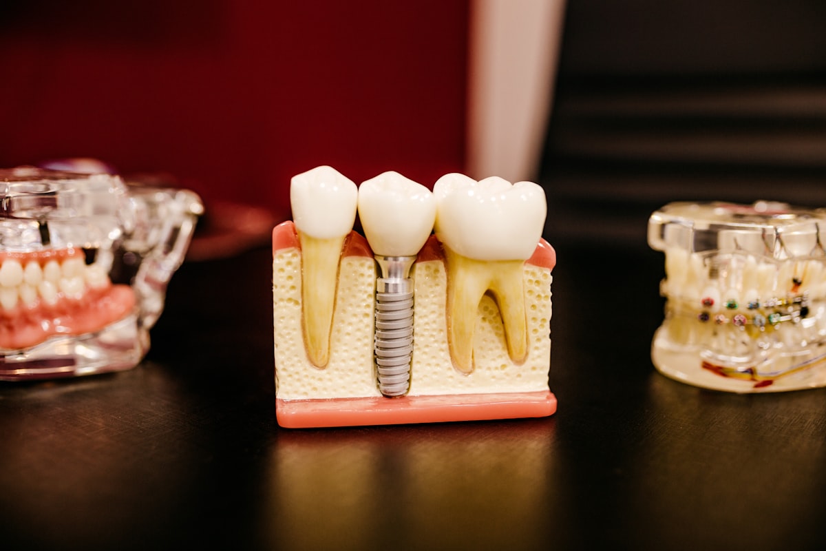 Modelo de implante dental de titanio con corona entre dientes naturales
