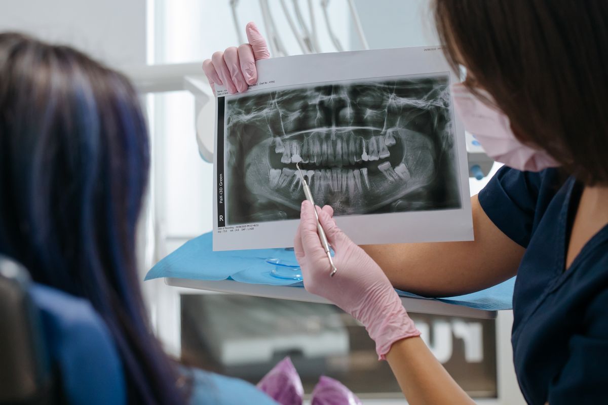 Implante dental integrado al hueso, base de su durabilidad a largo plazo