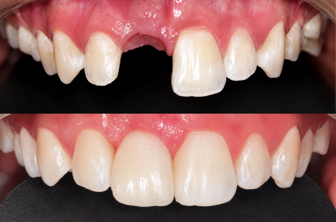 Antes y después de un implante dental en el sector anterior, diente frontal restaurado en Medellín
