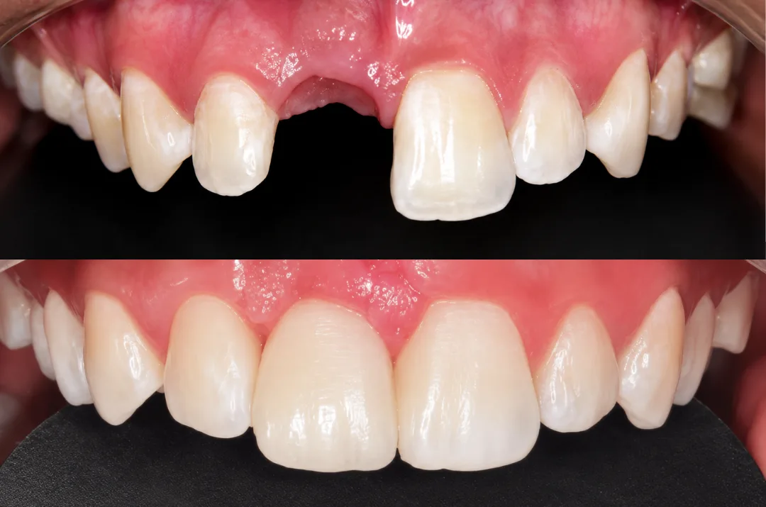 Antes y después de un implante dental en el sector anterior, diente frontal restaurado en Medellín