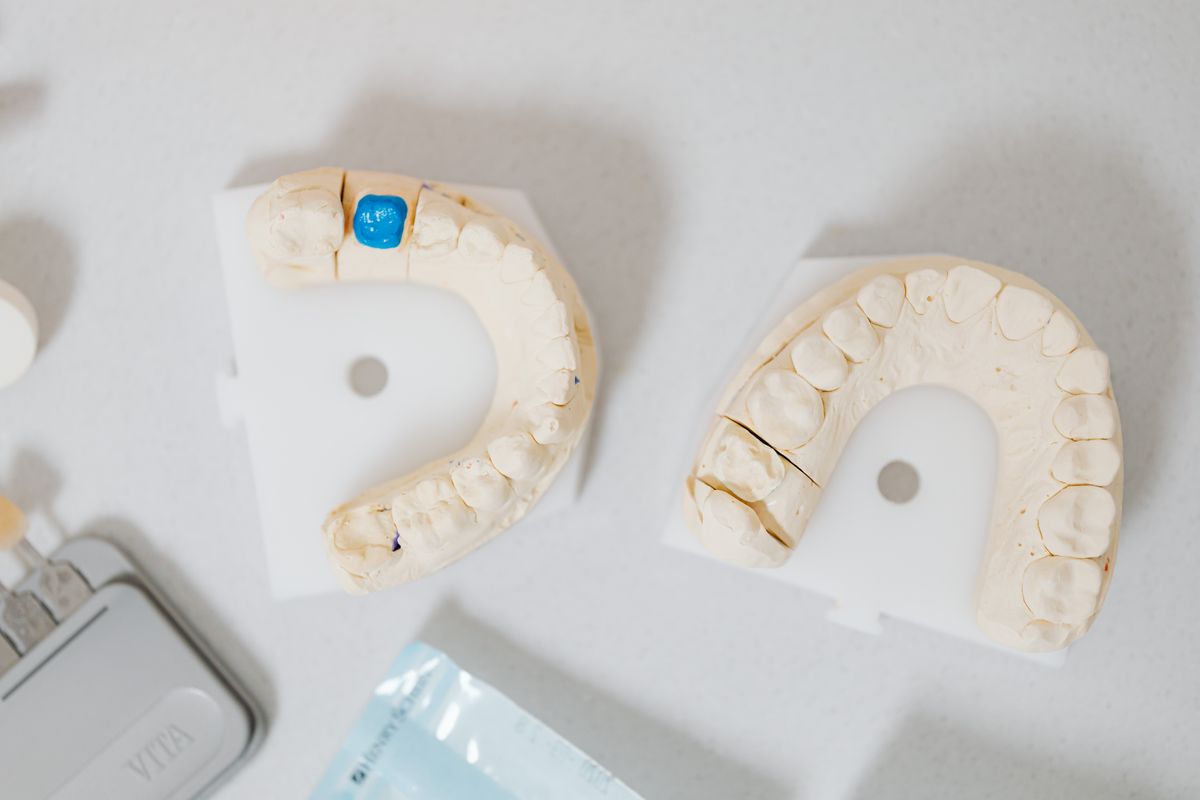 Modelos dentales de yeso usados para fabricar una incrustación dental en laboratorio