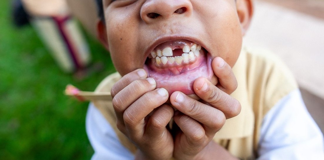 Niño sonriendo mostrando el espacio de un diente de leche caído