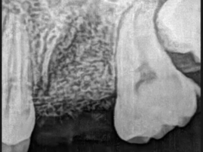 Regeneración ósea guiada antes de la colocación de un implante dental