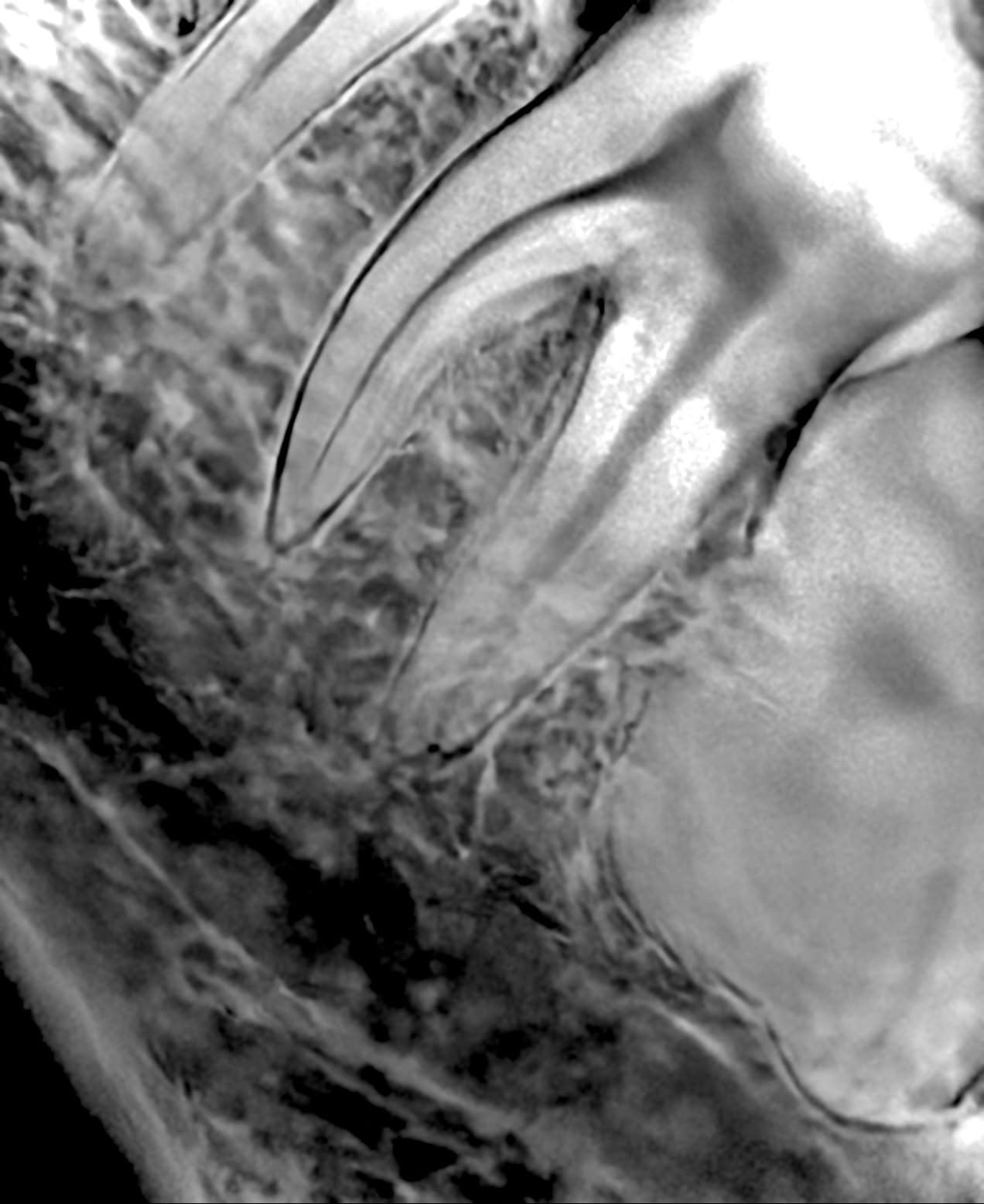 Radiografía dental periapical usada para el diagnóstico