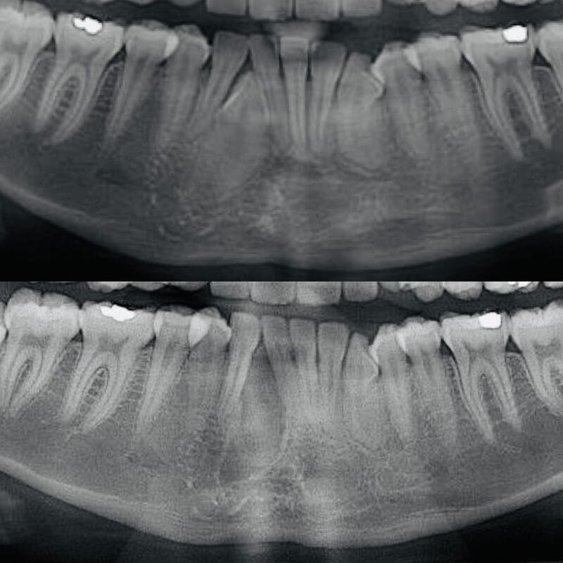 Exodoncia Supernumerario