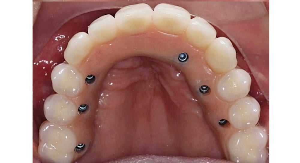 Prótesis total fija sobre implantes dentales en Medellín
