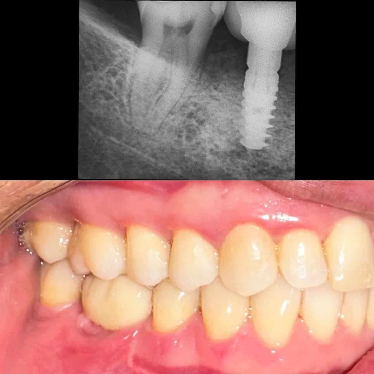 Rehabilitación de Implantes