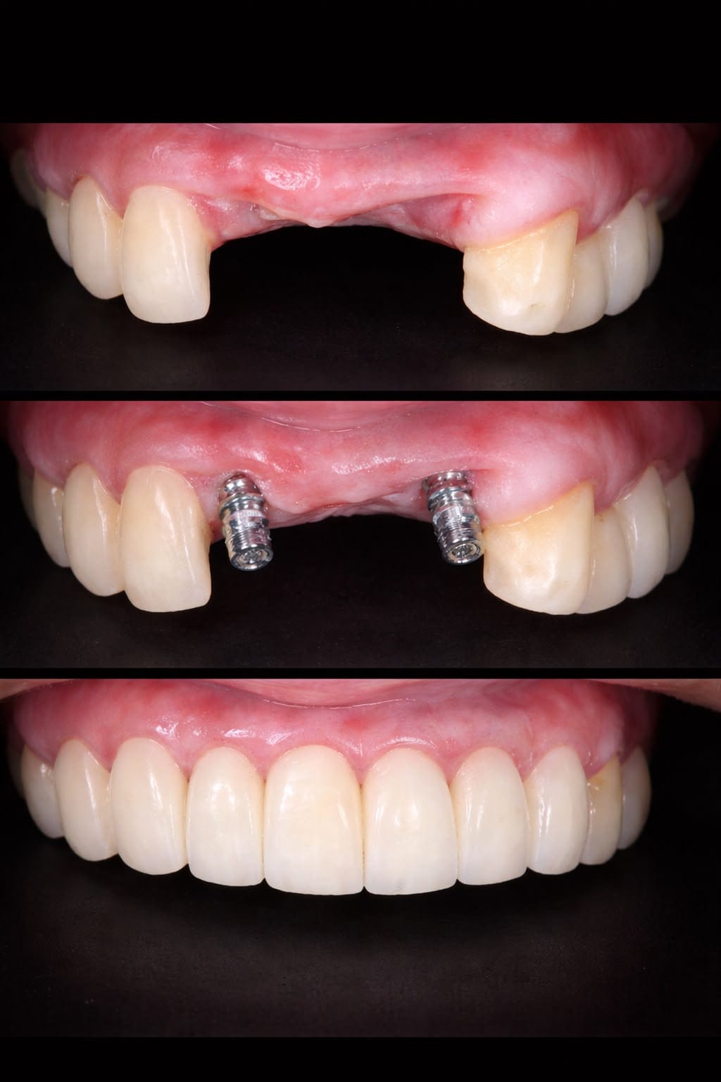 Rehabilitación Tramo de Implantes