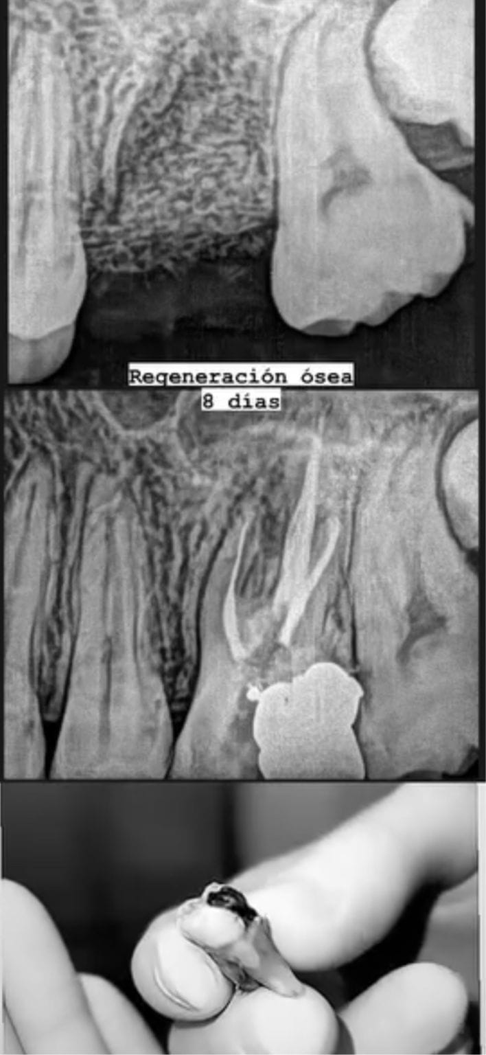 Regeneración Ósea Guiada