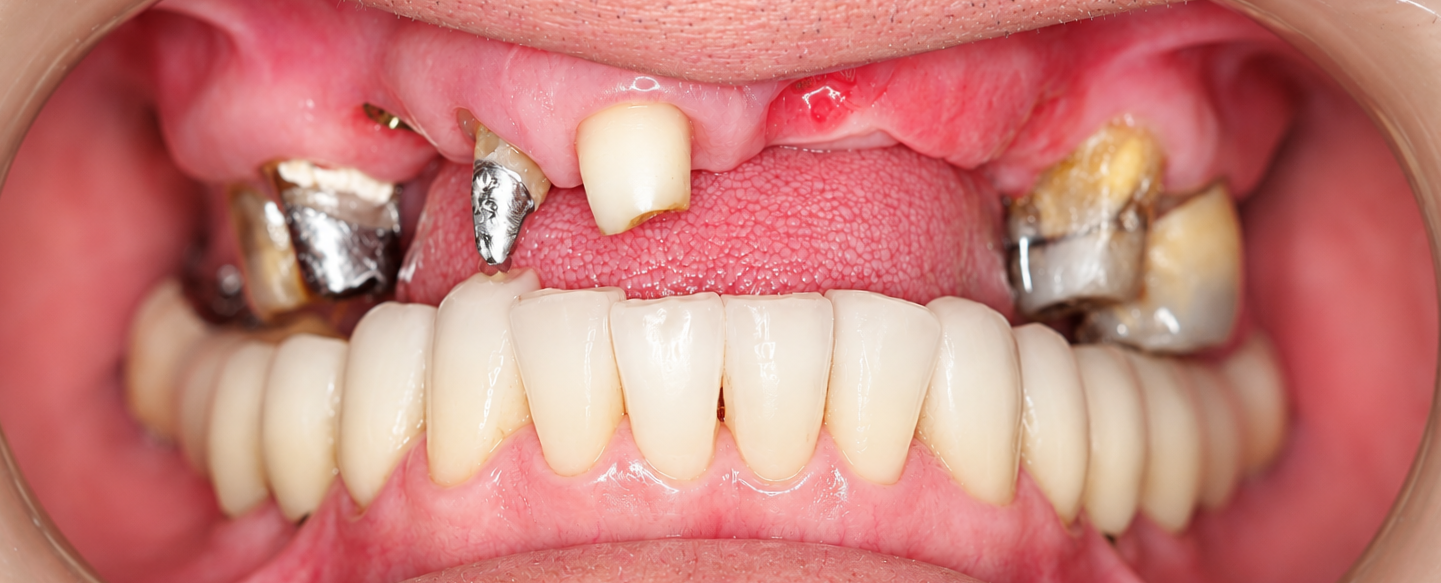 Rehabilitación oral - Antes