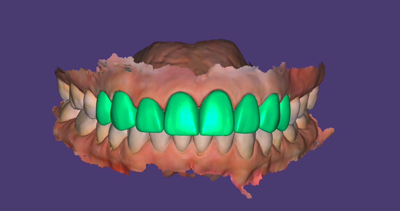 Planeación digital 3D diseño de sonrisa Bocas y Risas