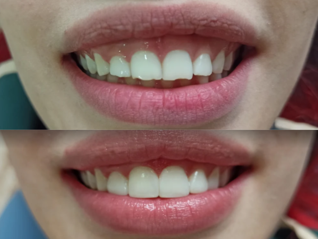 Antes y después microdiseño de sonrisa Bocas y Risas