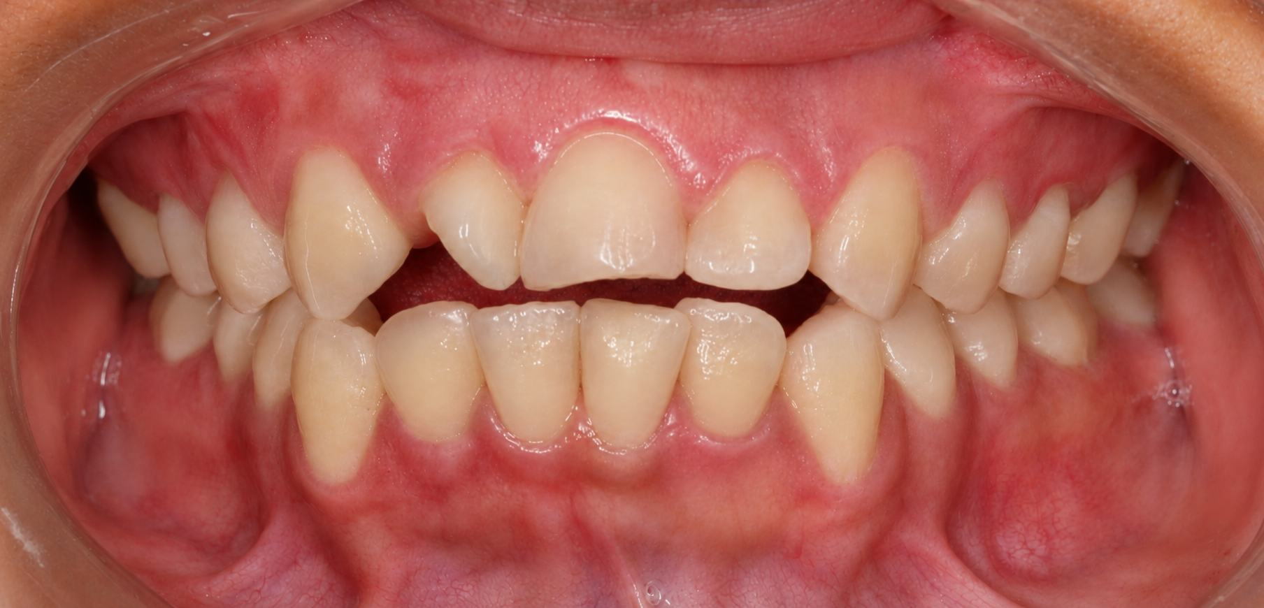Ortodoncia con brackets - Antes