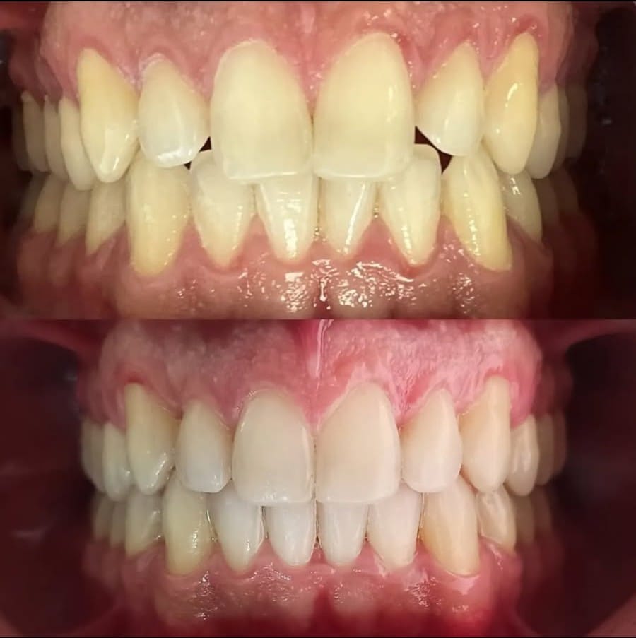 Antes y después ortodoncia brackets Bocas y Risas Medellín