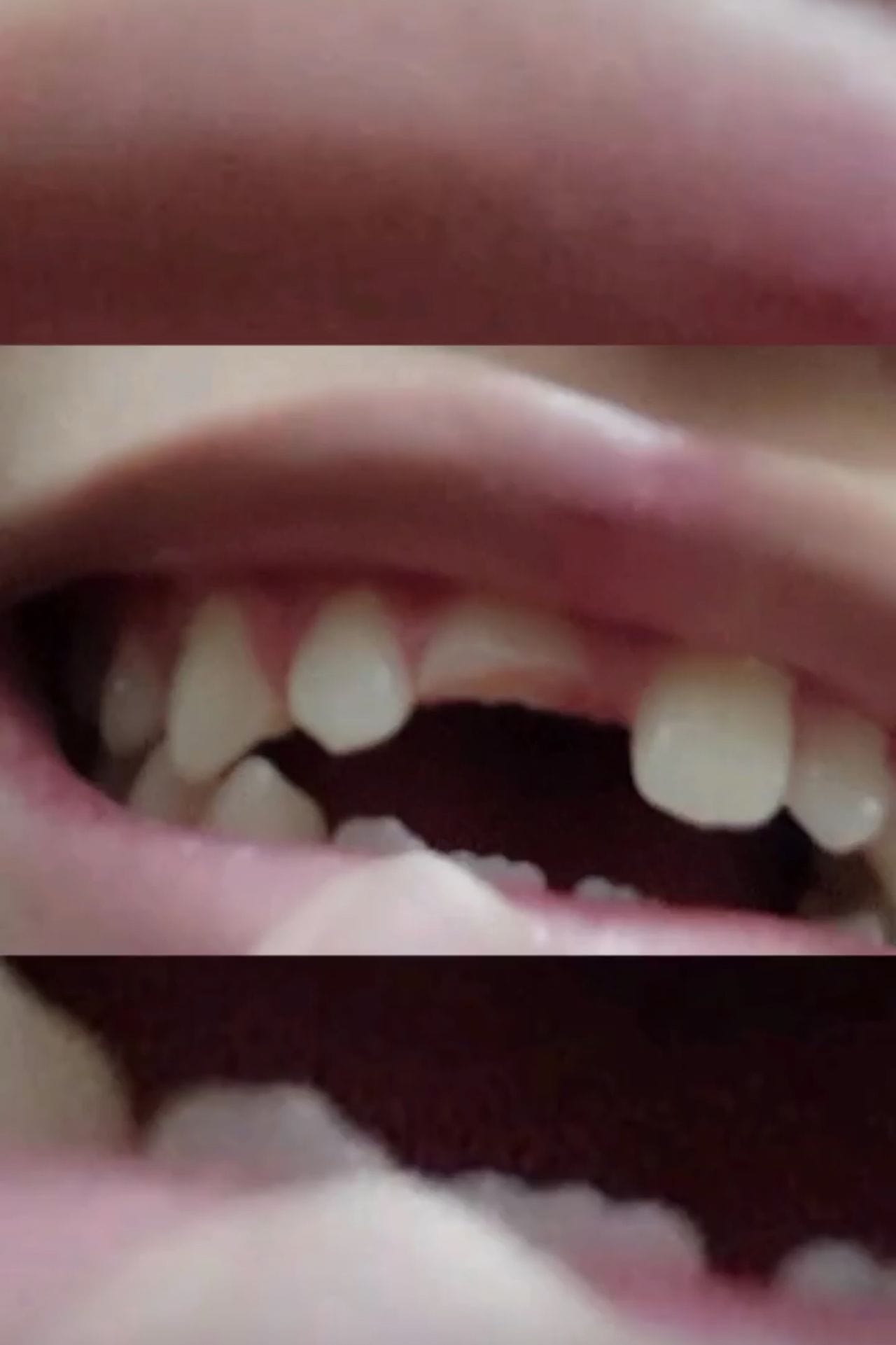 Espacio por diente perdido en traumatismo dental