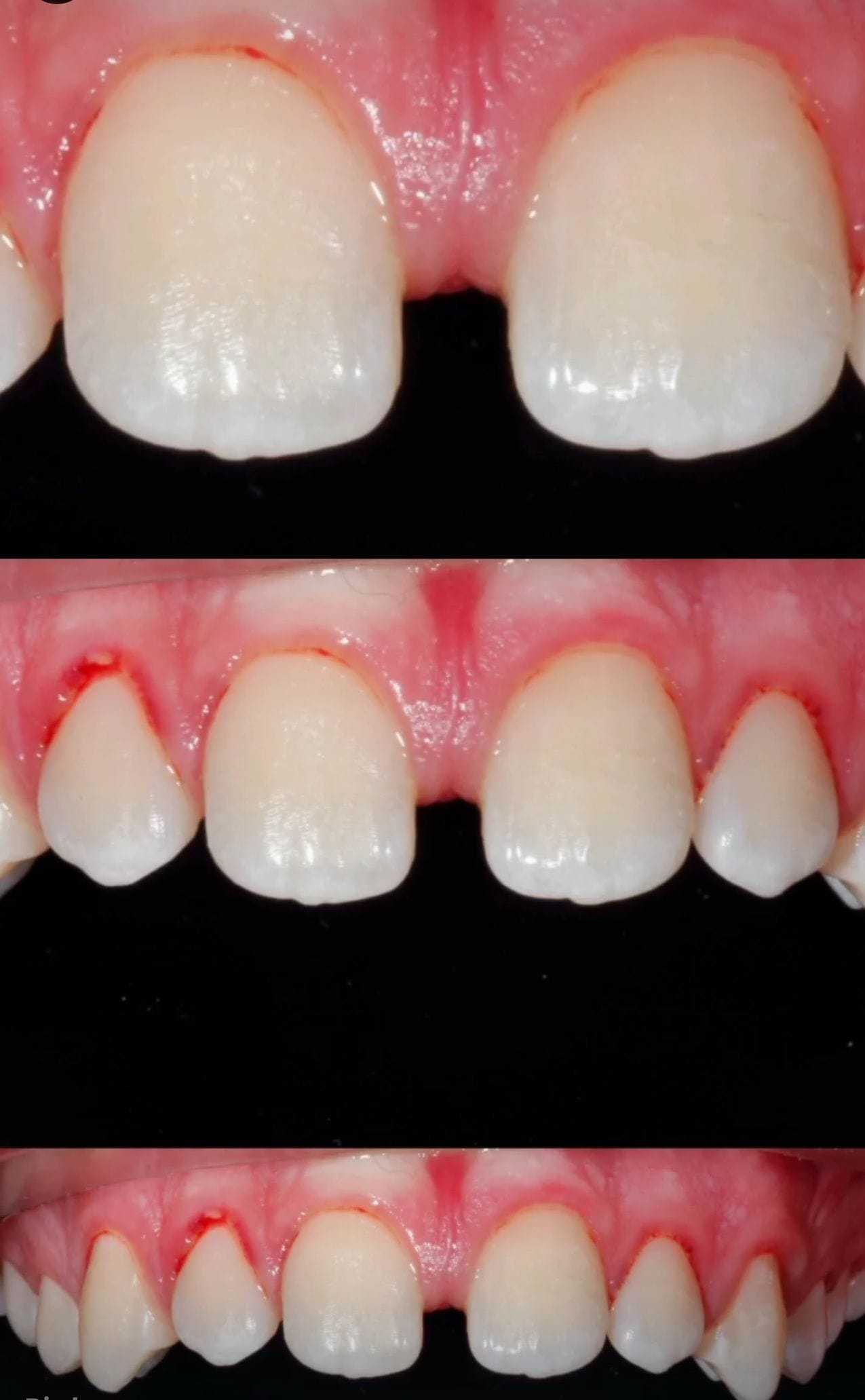 Secuencia de reconstrucción de dientes tras traumatismo dental: antes, durante y después