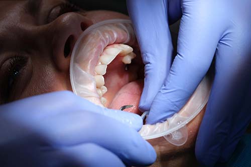 Instalación de carillas dentales