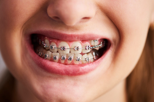 Joven con tratamiento de ortodoncia