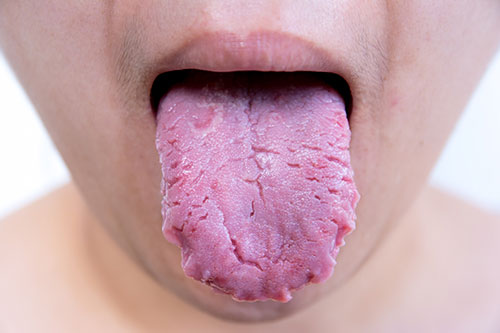 Enfermedad bacteriana en la lengua