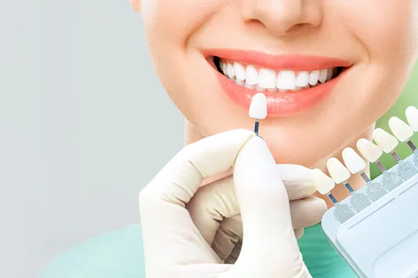 Selección de color para tratamiento de obturación dental con resina de fotocurado